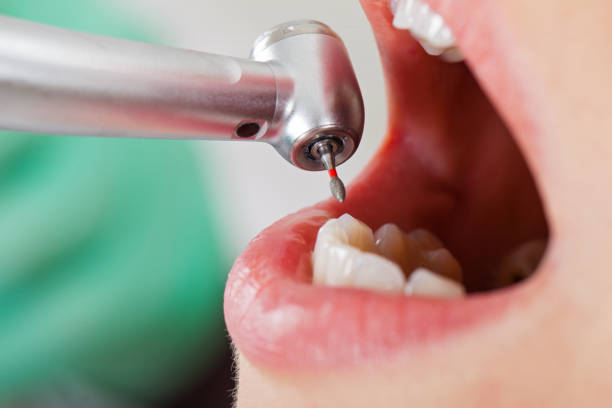 Best Emergency Wisdom Teeth Removal in Gallipolis, OH